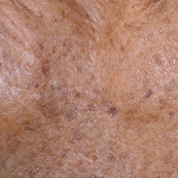 Actinic Keratoses on the Skin | Harley Street Dermatology Clinic