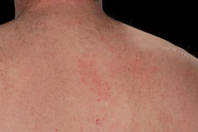 Psoriasis on back skin | Psoriasis Treatments in London | Harley Street Dermatology Clinic