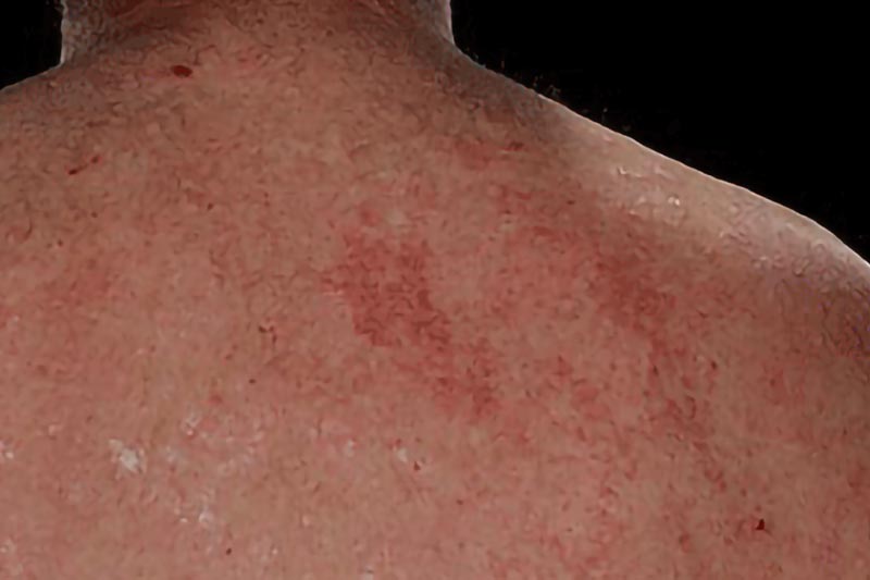 Severe Psoriasis on the Back | Harley Street Dermatology Clinic London