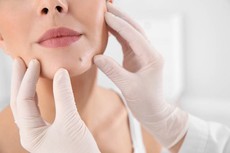 Dermatologist Checking Mole on the Chin | Harley Street Dermatology Clinic