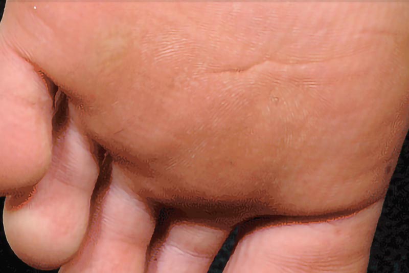 Wart on the bottom of the foot | Harley Street Dermatology Clinic