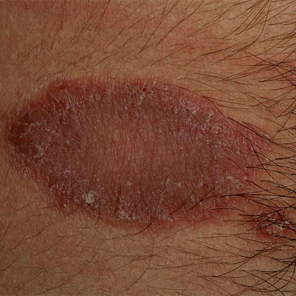 Large Discoid Eczema on the Skin | Harley Street Dermatology Clinics