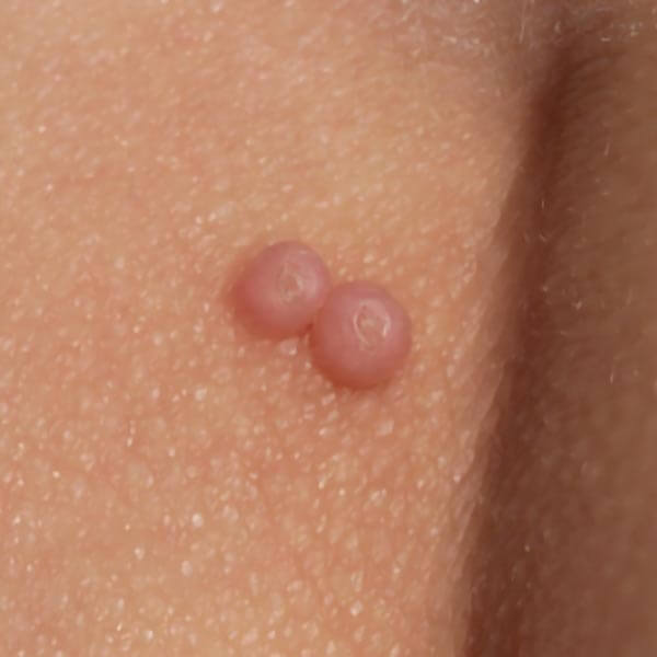 Childrens Molluscum on the skin | Harley Street Dermatology Clinic