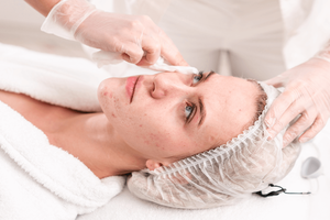 Acne treatment on the face | Harley Street Dermatology Clinic