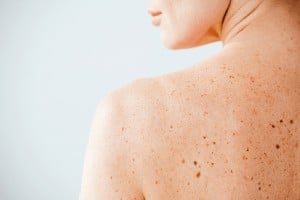 Moles on the Back | Harley Street Dermatology Clinic