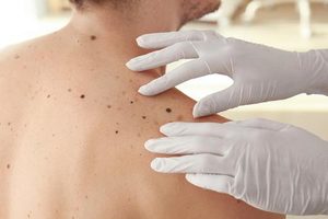 Dermatologist Checking Moles on Back | Harley Street Dermatology Clinic