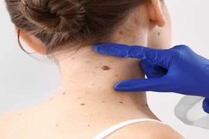 Dermatologist Checking a Mole on a Neck | Harley Street Dermatology Clinic