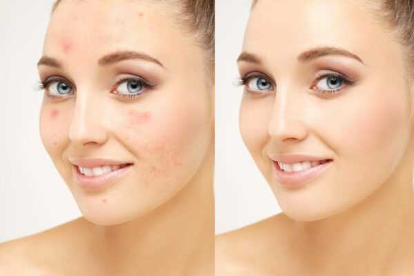 Post-Acne Marks /Treating Acne Scars.Acne Scar Removal