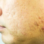 acne-scar-treatment