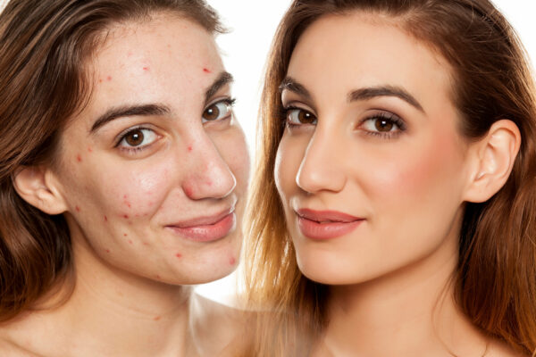 comparition portrait of same woman before and after cosmetic treatment amd makeup on white background