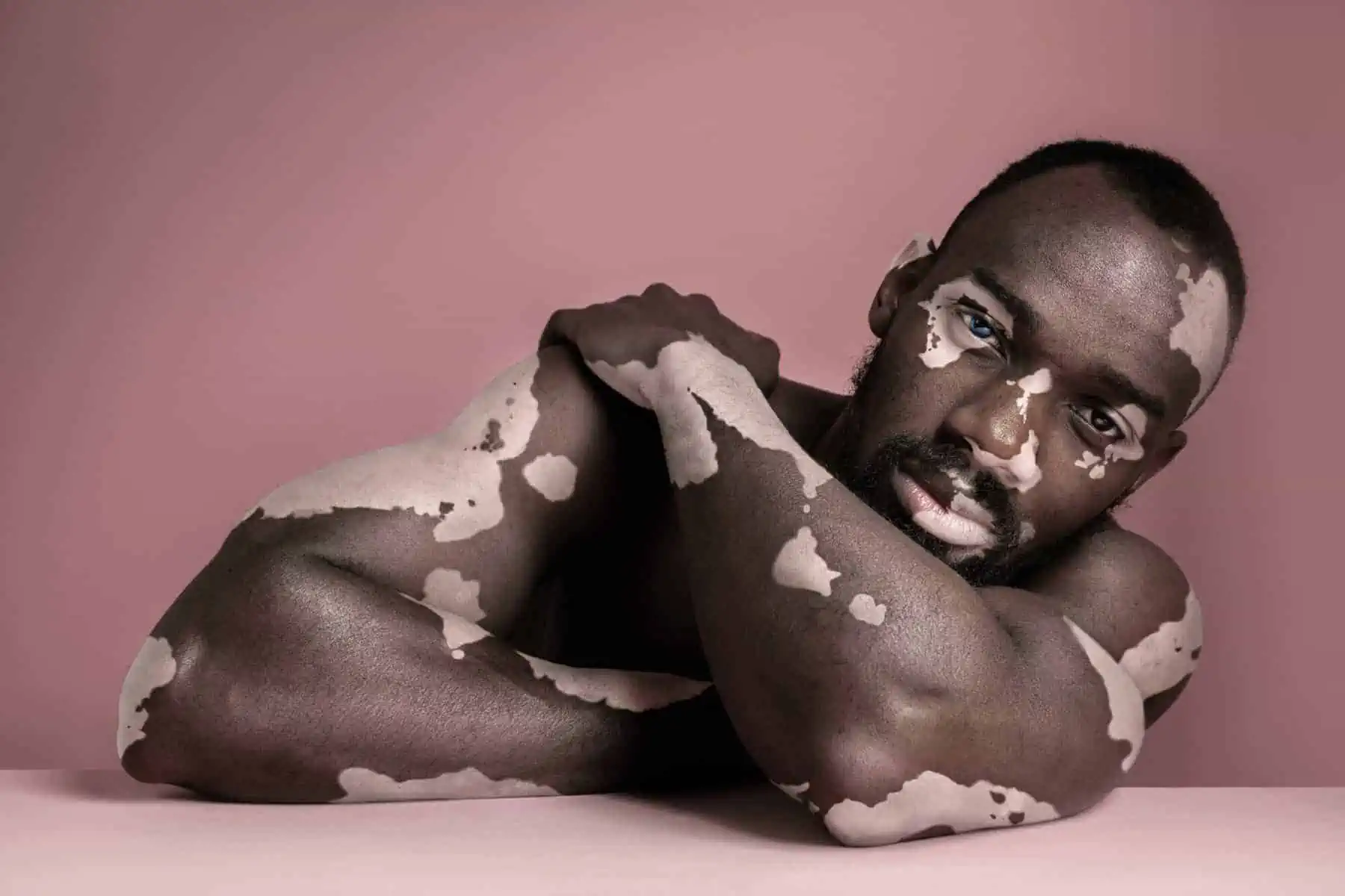 Are The Effects of Skin Conditions Underestimated?