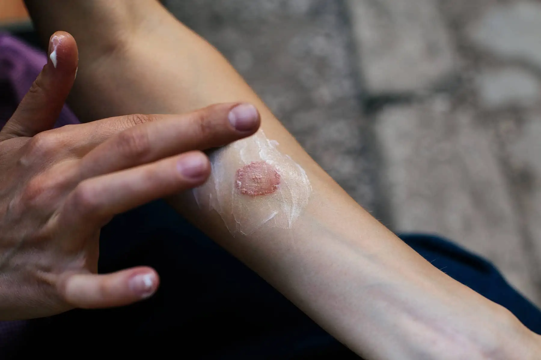 What is Ringworm?