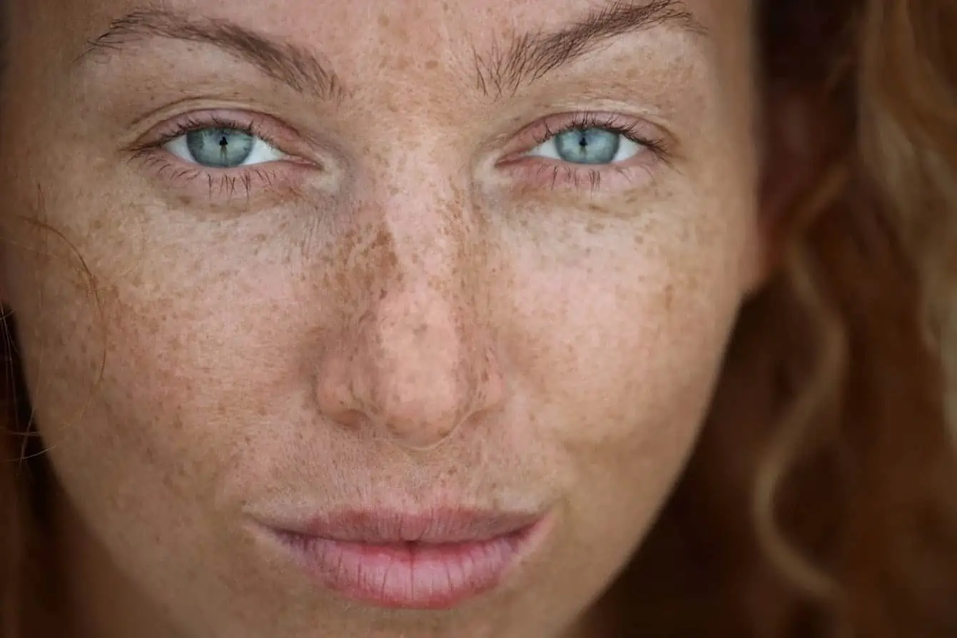 What is a Freckle and Can You Get Rid of Them?