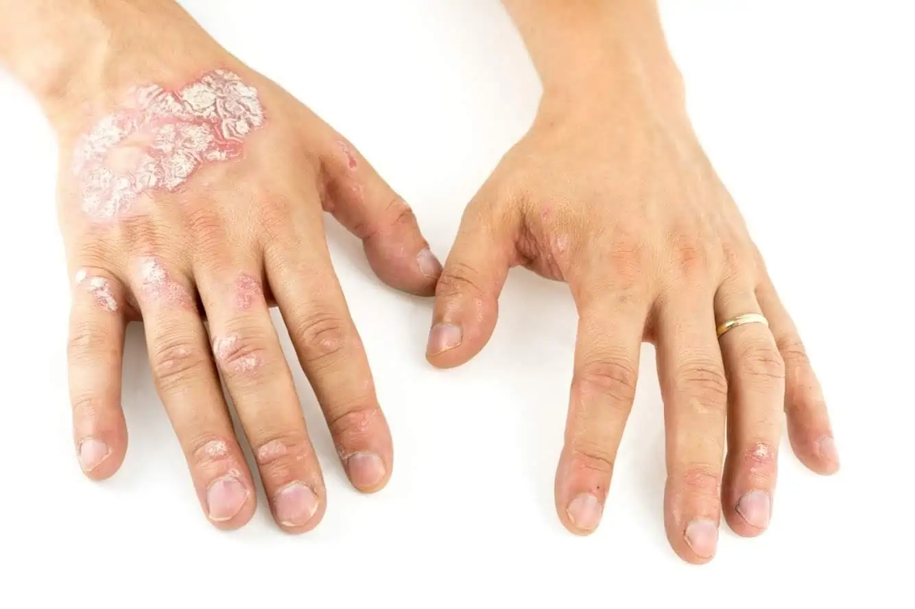 What is the Treatment for Psoriatic Arthritis?