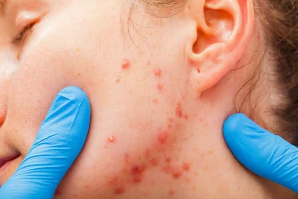 Are You Tired of a Relentless Acne Problem? Can Your Acne Be Treated?