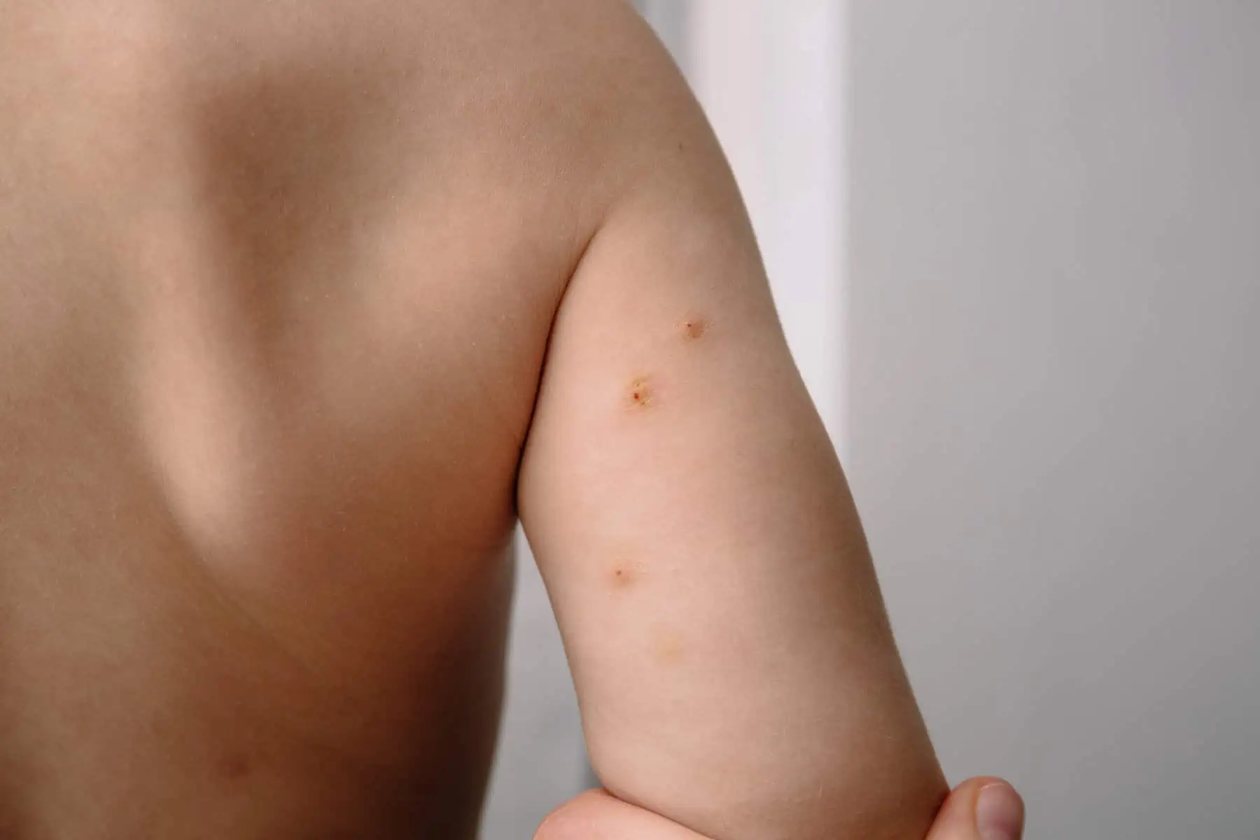 What is the Danger of Having Molluscum Contagiosum?