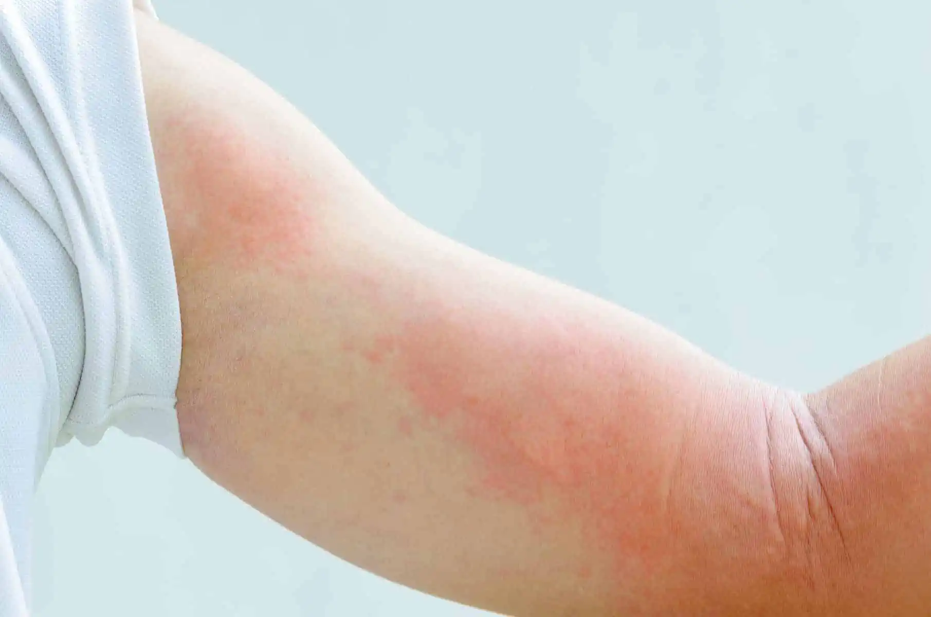 What are the Main Causes of Eczema?