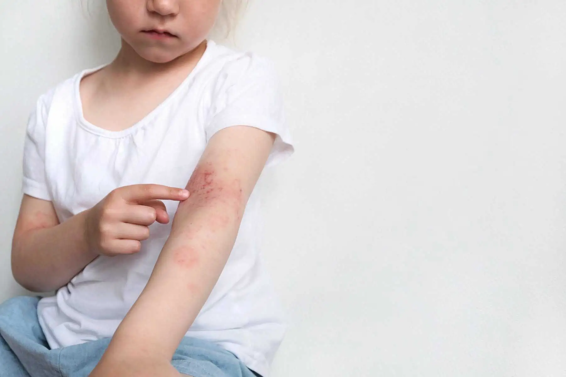 Why Are More Children Suffering from Skin Allergies Now?
