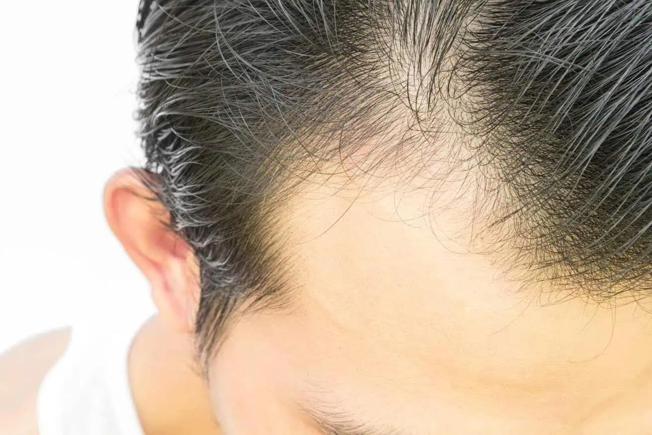 Do Supplements Help with Hair Loss?