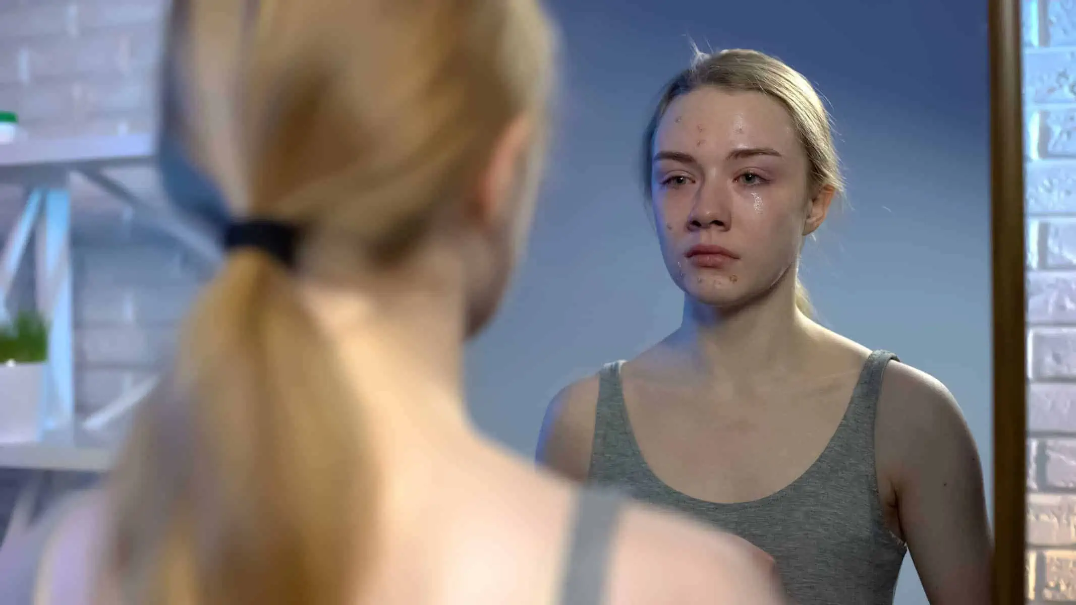 Why Do Some Teenagers Get Acne and Some Don’t? Adult Acne Information