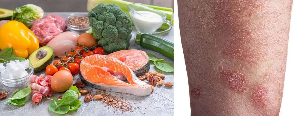 Is Our Diet Related to Our Skin Conditions?