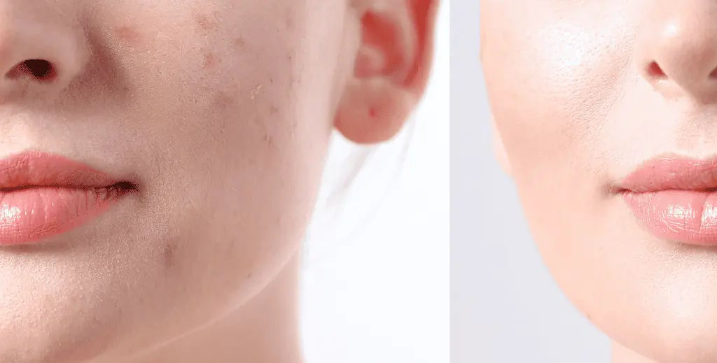 Is it worth seeing a dermatologist for acne?