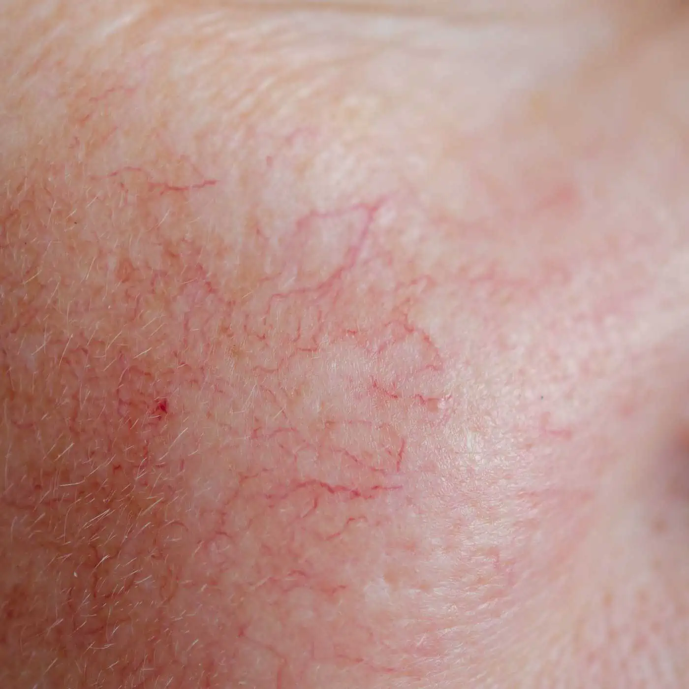 spider veins