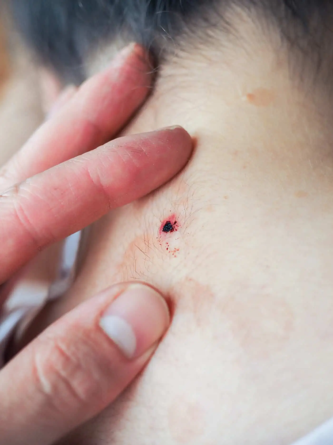 When Should I Worry About a Mole?