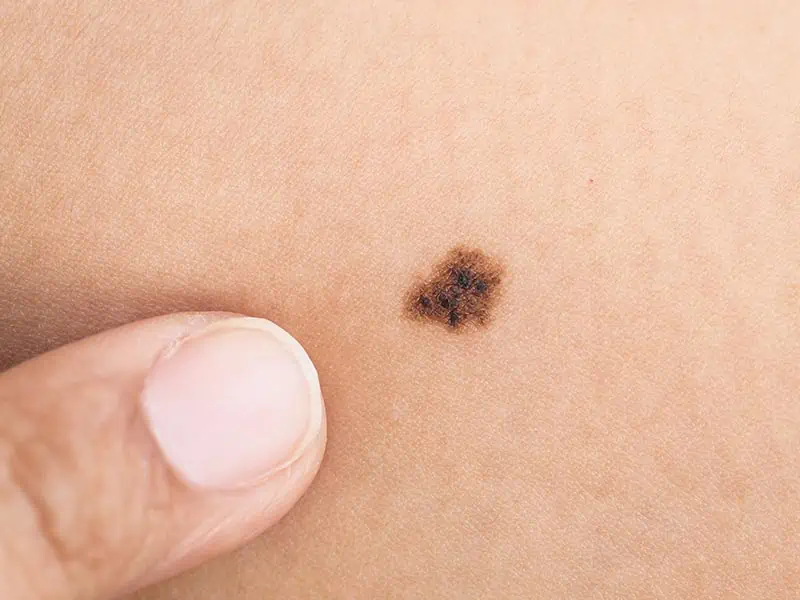Moles-Large-1.jpg