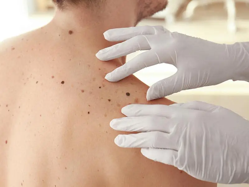 Worried about a mole?