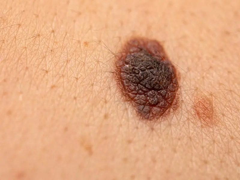 Moles-Large-4.jpg