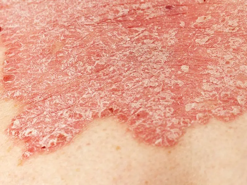 Psoriasis-Large-4.jpg