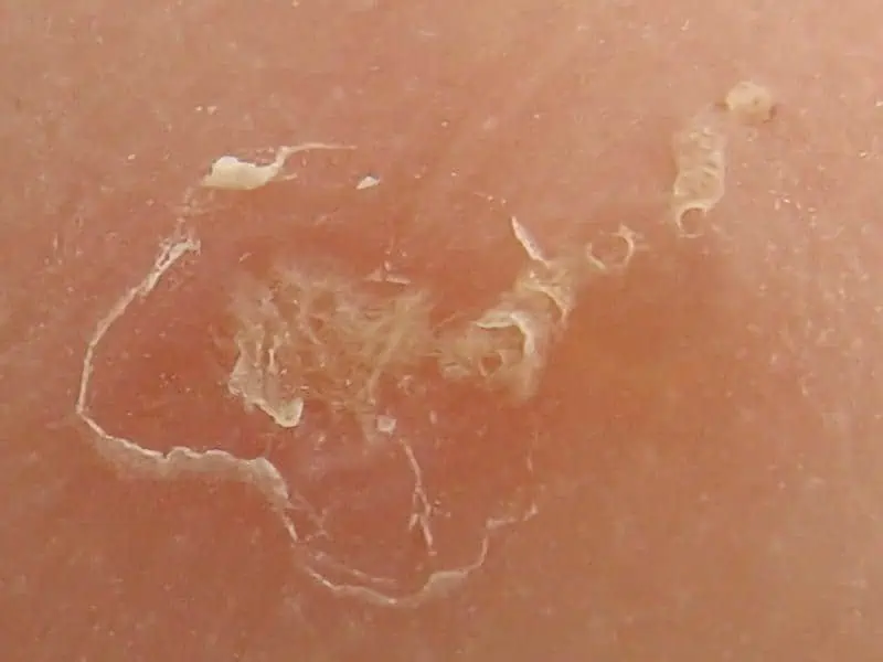 Scabies-Large-4.jpg