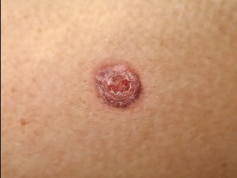 Squamous-Carcinoma-Large-6-1.jpg