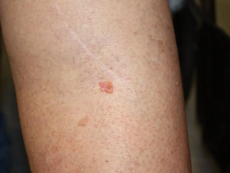 Squamous-Carcinoma-Large-7.jpg