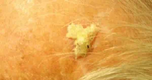 actinic-keratosis-300x158-1.jpg