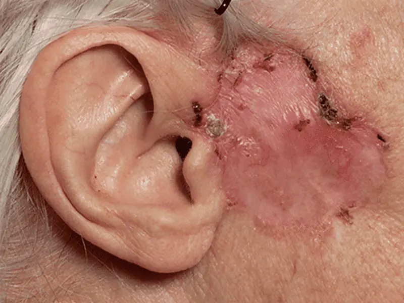 Is BCC (Basal Cell Carcinoma) a Completely Curable Disease? How?