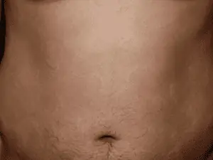 hives_0000_hives-300x225-1.png