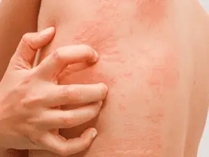hives_0006_AdobeStock_119502501-300x225-1.png