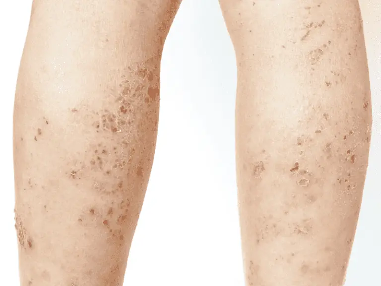 lichen-planus.png