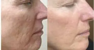 prp-before-and-after-e1665390159255.jpeg