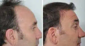 prp-hair-treatment-for-men-e1665390519598.jpeg