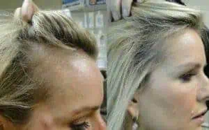 prp-hair-treatment-for-women-e1665390223632.jpeg