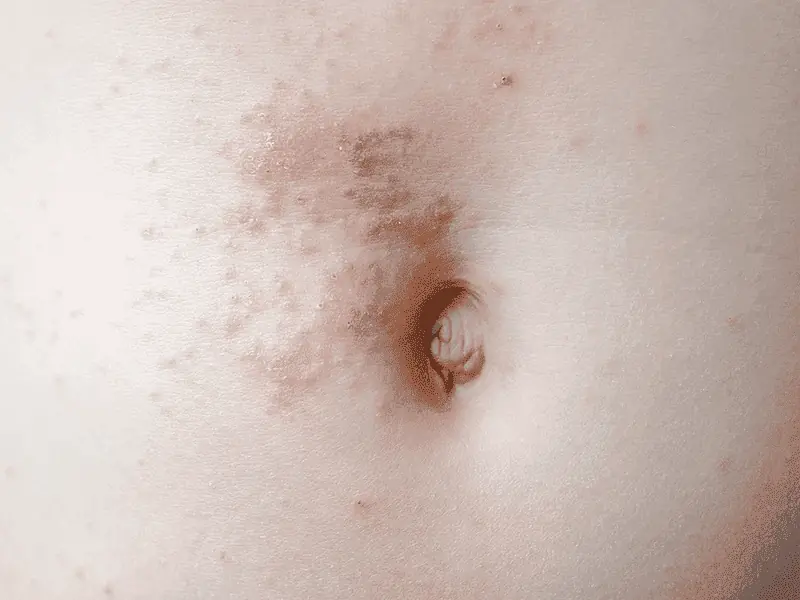 scabies.png