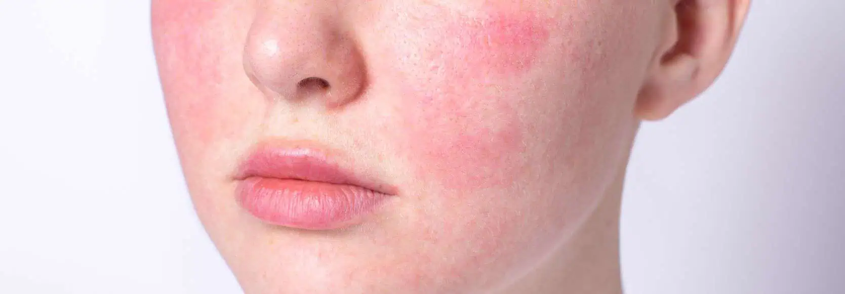 Understanding and Managing Rosacea: A Comprehensive Guide for Rosacea Awareness Month