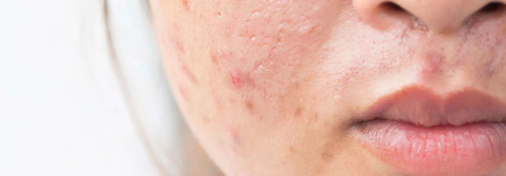 Acne Awareness Month: Understanding, Treating and Managing Acne