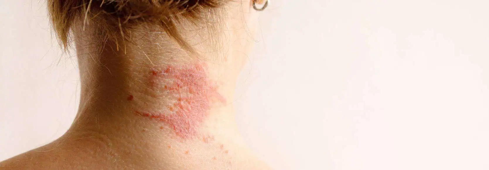 Eczema Awareness Month – A Guide to Understanding and Managing Your Skin