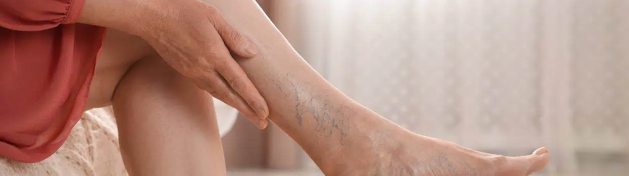 Varicose Vein Treatment London